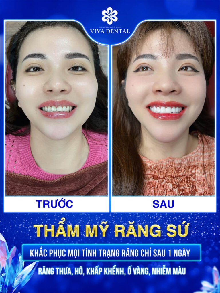 Trước và sau khi làm răng sứ