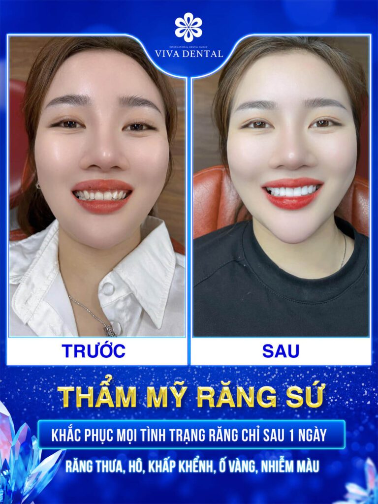 Trước/ Sau khi bọc răng sứ tại Viva Dental